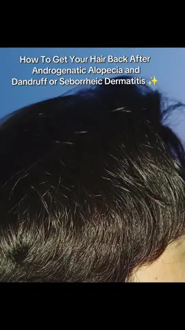 Basic routine to treat early stage of AGA and Seborrheic dermatitis aka Oily Dandruff. Note that it is the basic routine, you also need few other things to maximize the results, so check out my videos or msg me on insta (@numankhanbalach) for consultation. #foryou #foryoupage #alopecia #creatorsearchinsights #seborrheicdermatitis #dandruff #malepatternbaldness #minoxidil #minoxidilresult #hairloss #hairgrowth #naturaldhtblocker #fyp 