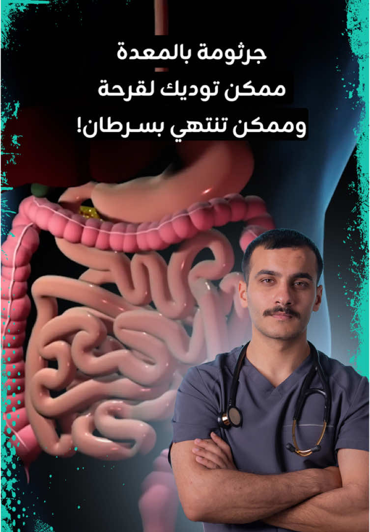 جرثومة بالمعدة ممكن توديك لقرحة وممكن تنتهي بســرطان!.. . . . #اكل #صحة #طبيب  #طبي #جرثومة_المعدة  #انتبه 