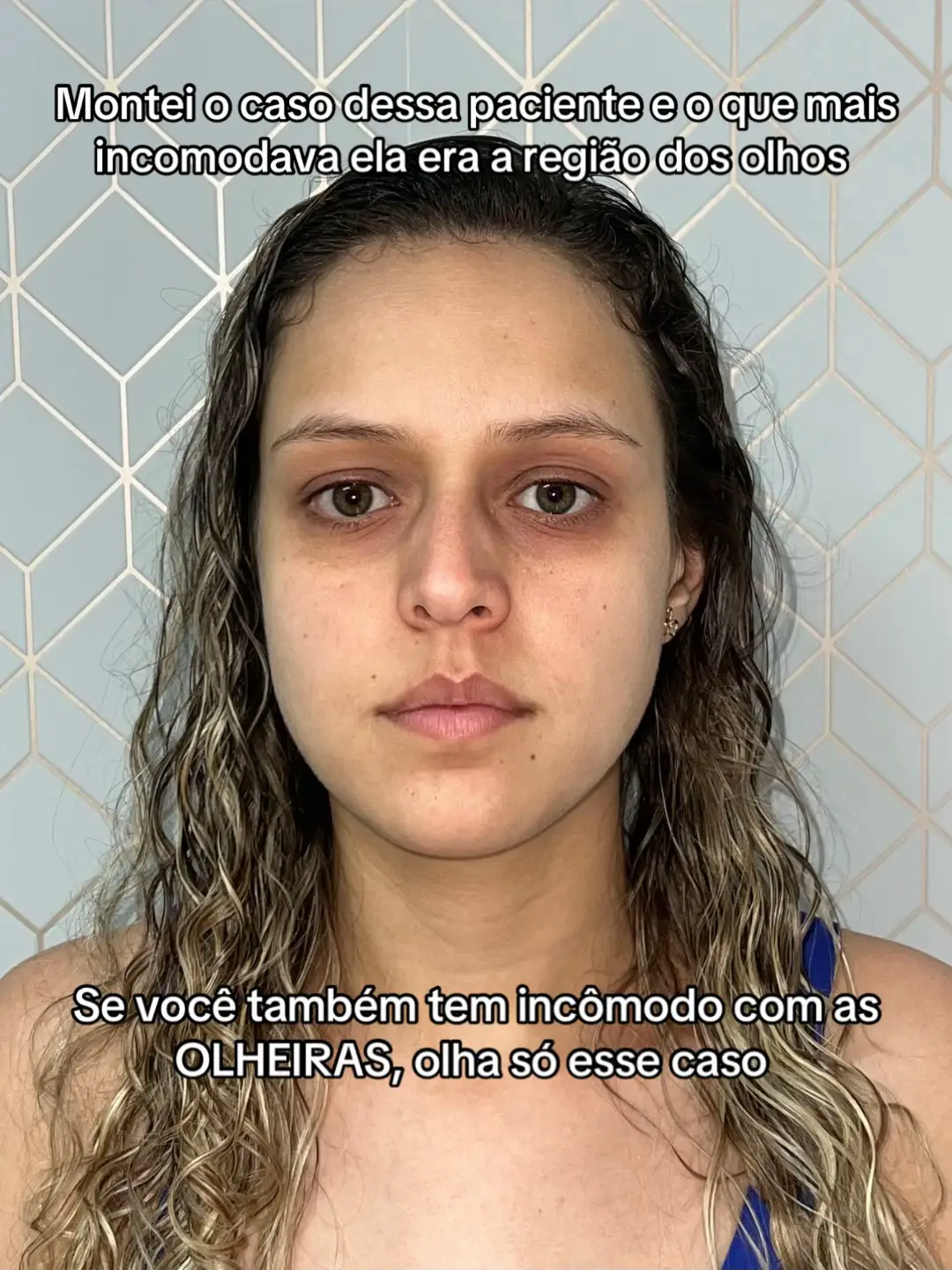 Solução para olheiras? TEMOS! ☑️ #preenchimentomalar  #olheirasescuras #peeling 