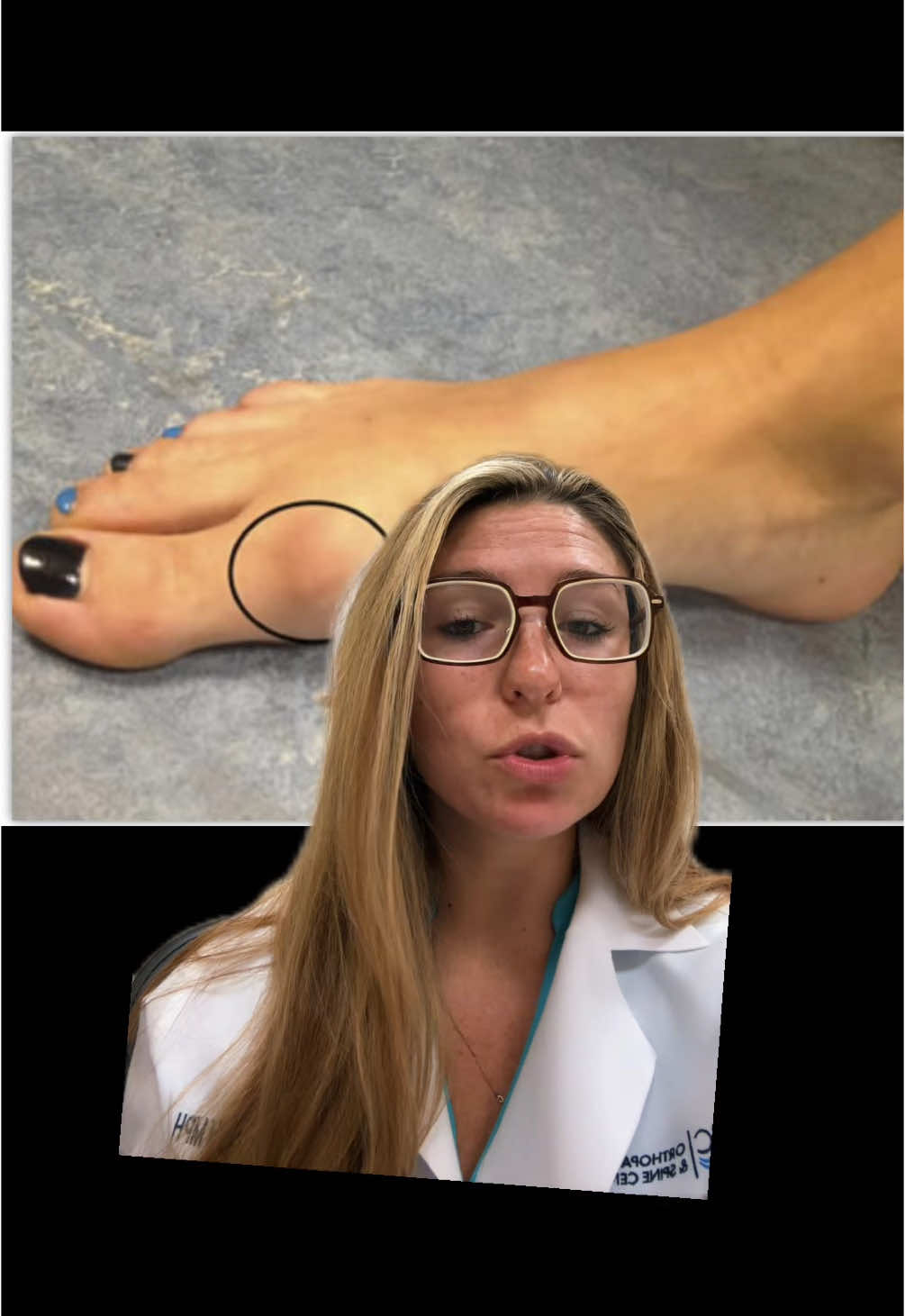 let’s talk big toe arthritis  #arthritispainrelief #footsurgeon #footsurgery 