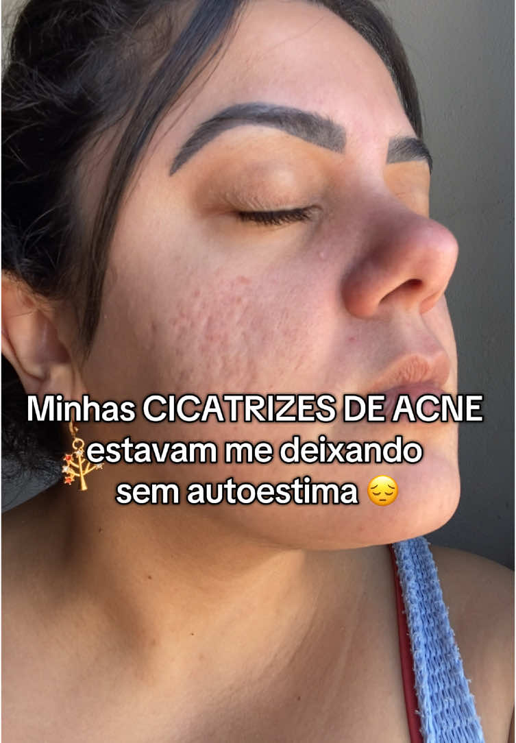 Minhas CICATRIZES DE ACNE sempre me incomodaram 😔testei um creminho que mudou tudo, em 2 MINUTOS já deu resultado! Se quiser saber mais é só me chamar 🥰 #cicatrizes #cicatrizesdeacne #antesedepois #DáUmaVoltinha #pelesaudavel #skincare #acneskincare #acnenuncamais 