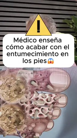 ⚠️😰⚠️#neuropathyrelief #neuropatiadiabetica #neuropathy 