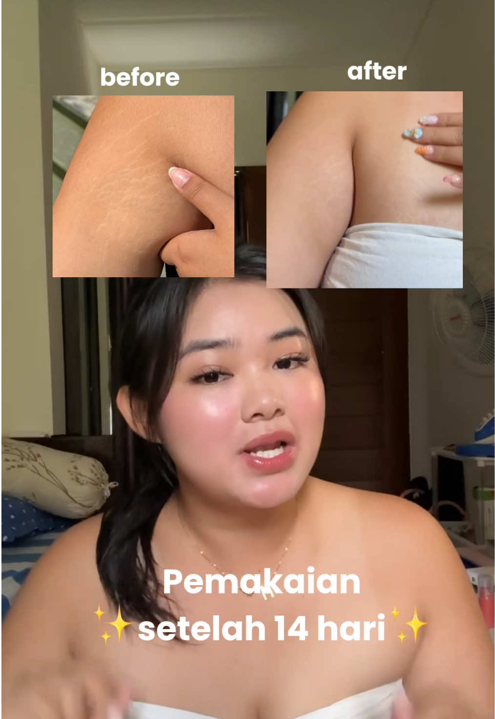 Lumayan memudar setelah 14 hari omg! Yang penting harus rajin pakenyaa sih @Ciara Indonesia !! Cream nya mosturize banget + wangii makanya aku suka pake abis mandi👍 #stretchmarks #stretchmarkserum #stretchmarkoil 