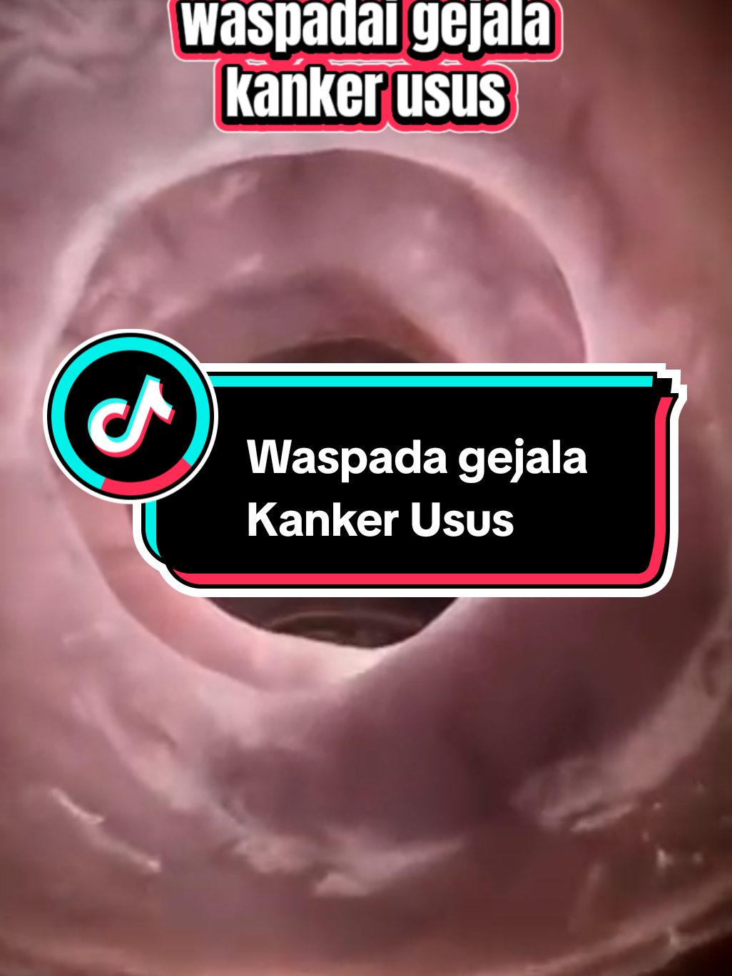 hati-hati dan waspadai gejala kanker usus, pentingnya menjaga kesehatan dan kebersihan usus kita dengan cara rutin detoksifikasi usus, karna usus yg kotor salah satu penyebab terjadinya berbagai macam penyakit #detoksifikasi  #detoxususkotor  #tehdetoxazbo 