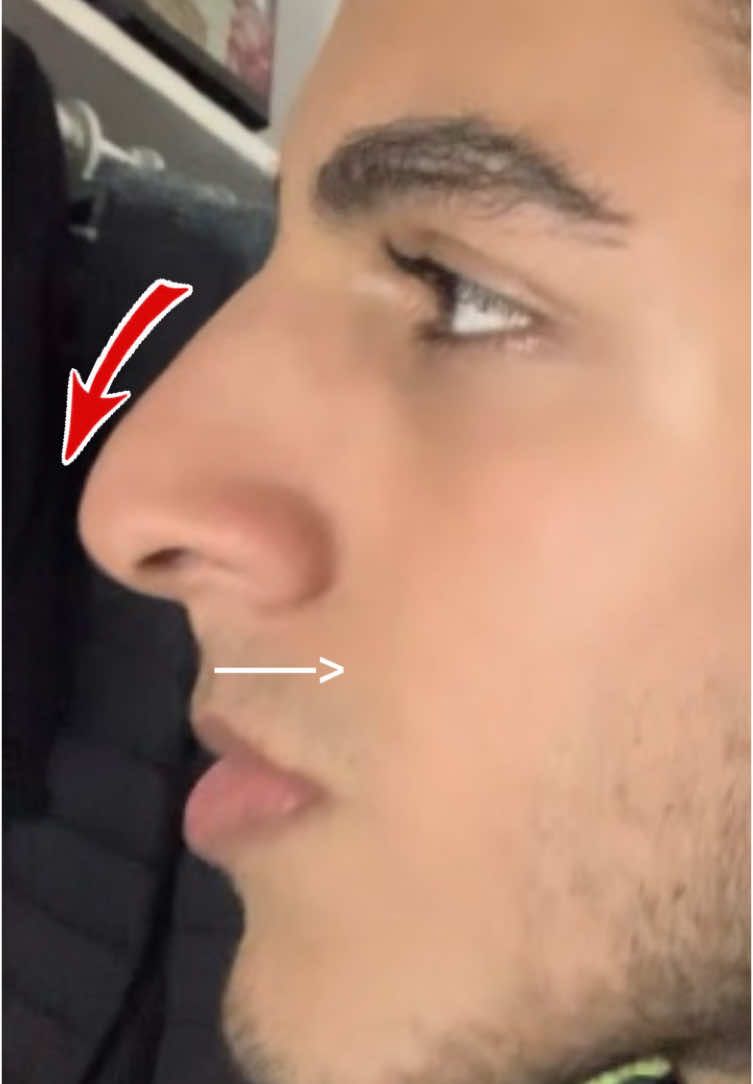 The problem isn’t your nose. Your issue is something else… It’s your maxilla that determines whether your nose will look upturned or have a droopy tip.  Look, in the video I normally have a nose with a droopy tip, but when I simulate the projection I lack, it becomes ideal. This is for you to understand that the problem isn’t your nose — there’s no point in getting a rhinoplasty without fixing your maxilla projection. So how do I change this? For now, I don’t have a clear answer — the only real option is orthognathic surgery, with a maxillofacial surgeon. However, I’m still on that journey. First, I need to fix my crossbite, which is my main issue. . . . #fypシ゚ #looksmaxing 