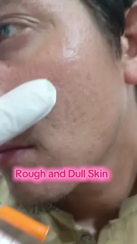 Dull and Rough Skin. Advance Face Prp with Micro needling. Dm if you are interested. 1.Nawaz Medical Center Sakhakot Bazar adda. 2.Waseem medical Complex Batkhela (Friday, Saturday, Sunday.#capcut #fyppppppppppppppppppppppp #foryoupageofficiall #Strong #beauty ##ConSantanderConecto #viral 