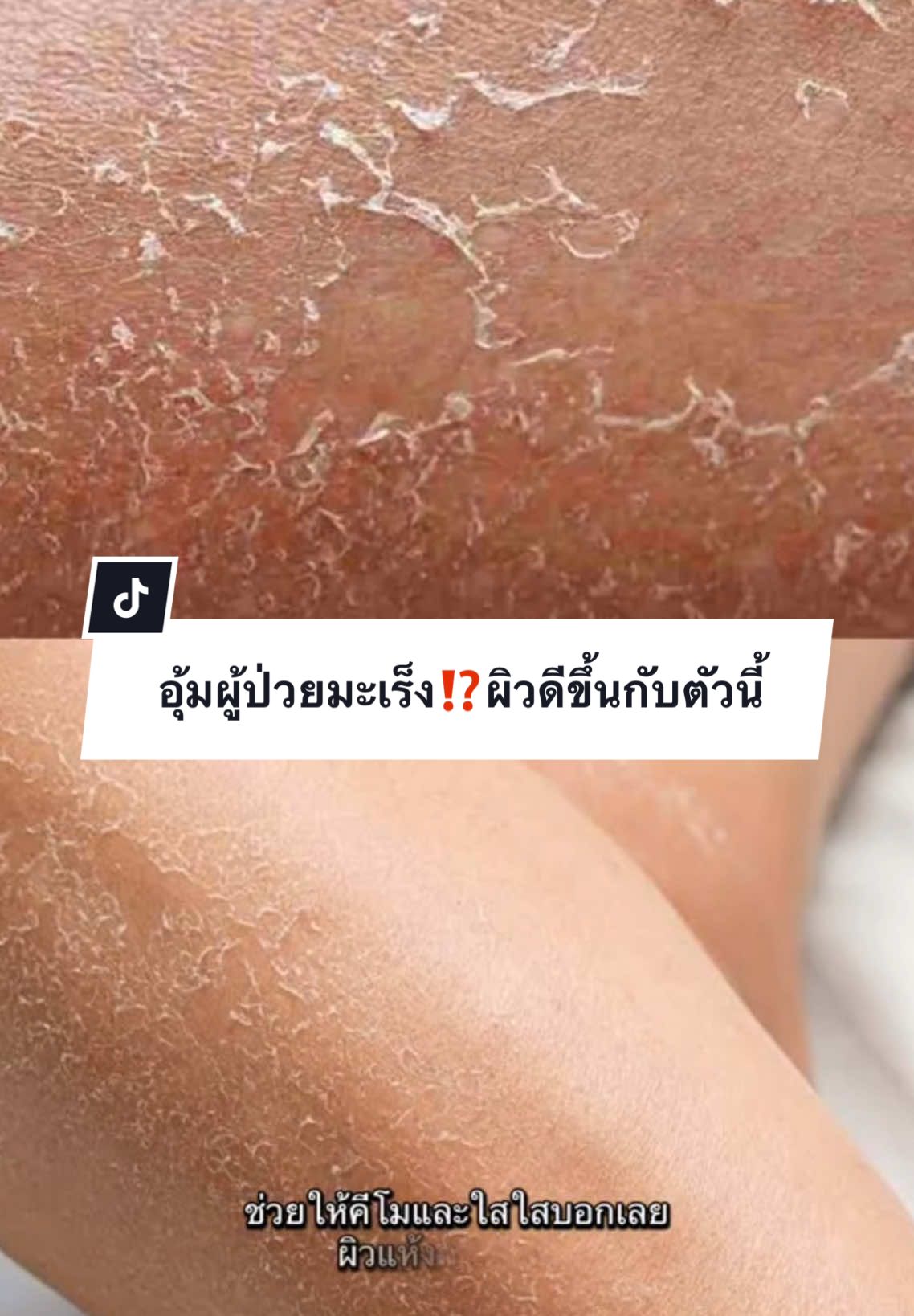 เพื่อนที่รู้ใจ เรื่องผิวคนเป็นมะเร็ง อุ้มเลือกอิมูร่าโลชั่นและลิปอิมูร่าจ้า… #อิมูร่าโลชั่น #อิมูร่าลิป #อิมูร่า #ผิวแห้ง #ผิวลอก #ผิวแดง #อิมูร่าเท่ากับอุ้ม #เทรนด์ #ผู้ป่วยที่ไม่รู้ระยะว่าตัวเองอยู่ระยะไหนเพราะหมอไม่ได้บอกค่ะรู้ก็ทำอะไรไม่ได้ค่ะ #ผู้ป่วยมะเร็งที่ไม่เหมือนผู้ป่วย #มะเร็งก็เหมือนไข้หวัดค่ะ #ผู้ป่วยมะเร็ง #มะเร็งตัวร้าย 