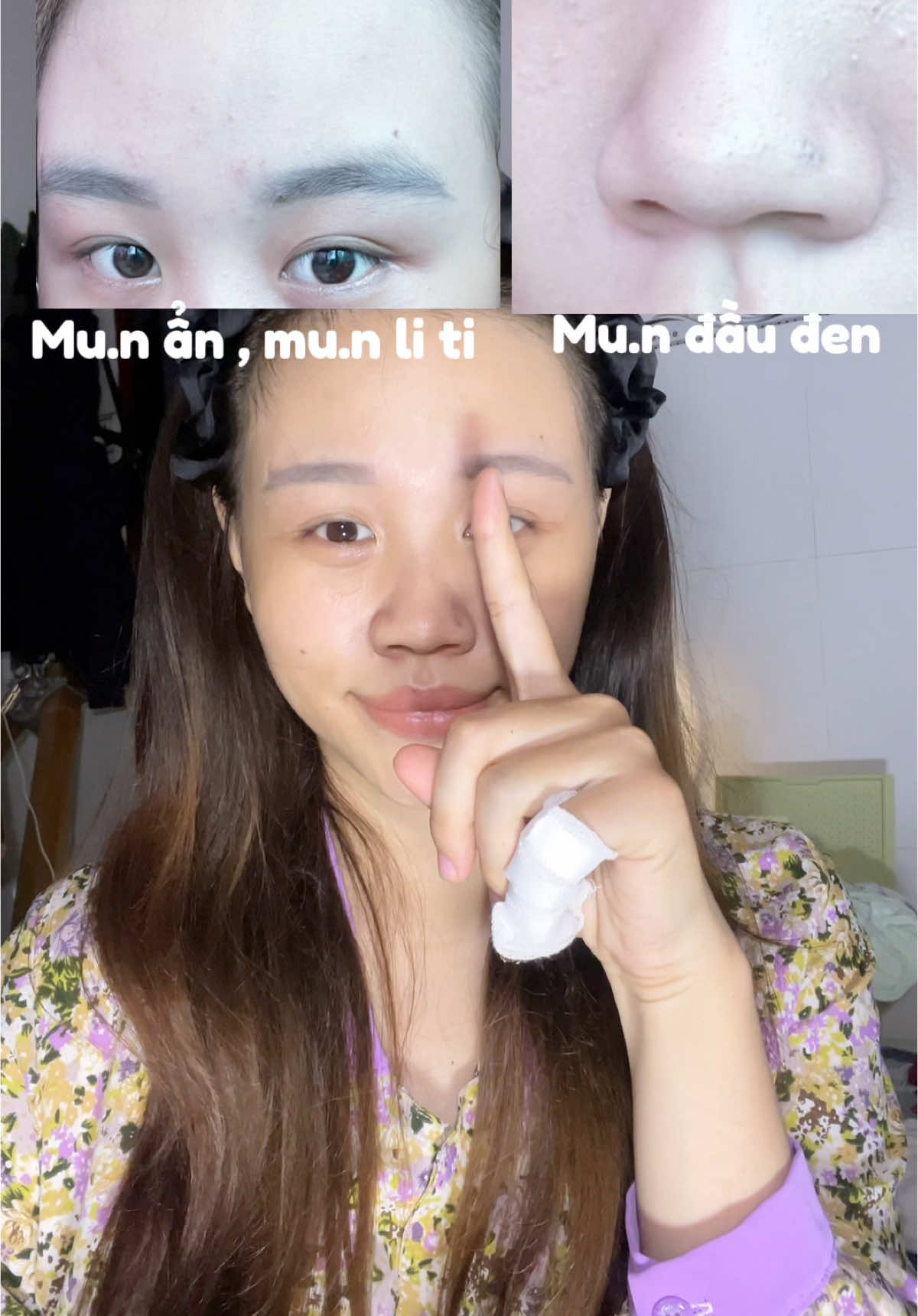 Đang có deal mua 1 tặng 1 đó mấy bà  #dermatidem #dermatidemplusgel #e&gbeauty #skincare #thammun #chamsocda #mun #trimun #tritham 