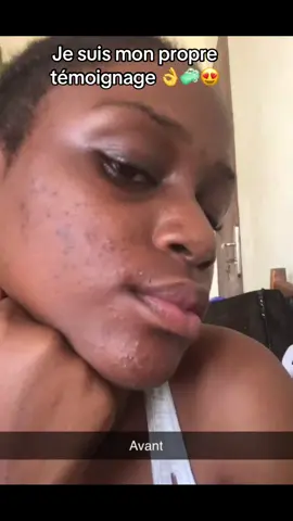 Mon avant et après 😆❤️ mes imperfections de la grossesse #libreville_gabon🇬🇦🇬🇦🇬🇦🌹 #gabontiktok🇬🇦 #temoignage #vuestiktok #viralvideos #publicite #boutons #acneskin #visage #gommage #cosmetique #cotedivoire🇨🇮 #camerountiktok🇨🇲 #togolais228🇹🇬 #burkinatiktok🇧🇫 #benintiktok🇧🇯 #marocaine🇲🇦 #france #temoignage #visibilitesurtiktok #astucetiktok #astuce 