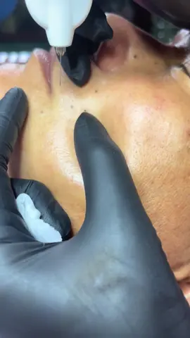 #videotrieuview #xuhuongtiktok xử lý nốt ruồi bằn plasma