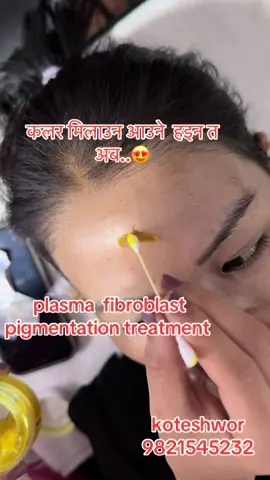 #plasma #scar #pigmentation #wrinkles #acne#pigmentation #wrinkles #acne #pigmentation #fyppppppppppppppppppppppp #goviral 