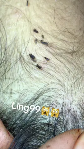 Remove lice#omg #lice #liceremoval 