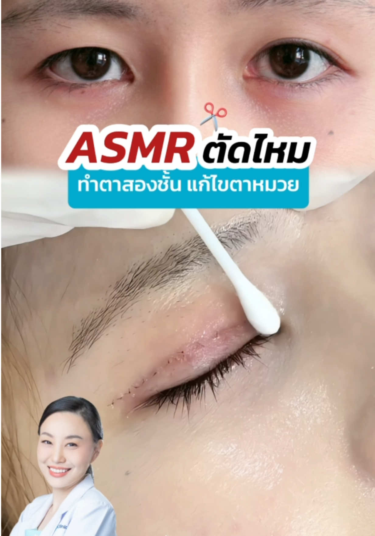 ASMR ตัดไหม ทำตาสองชั้นครบ 7 วัน #skyclinic #สกายคลินิก #sweeteyes #หมอสกาย #จักษุแพทย์ #ทำตาสองชั้น #กรีดยาว #skyclinic_drsky #asmr 