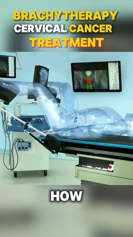 This Is How Brachytherapy Targets Cervical Cancer from Within! #Brachytherapy #CervicalCancer #CancerTreatment #MedicalExplained #DoctorTok #TikTokHealth #HowItWorks #WomensHealth #RadiationTherapy #HealthAwareness