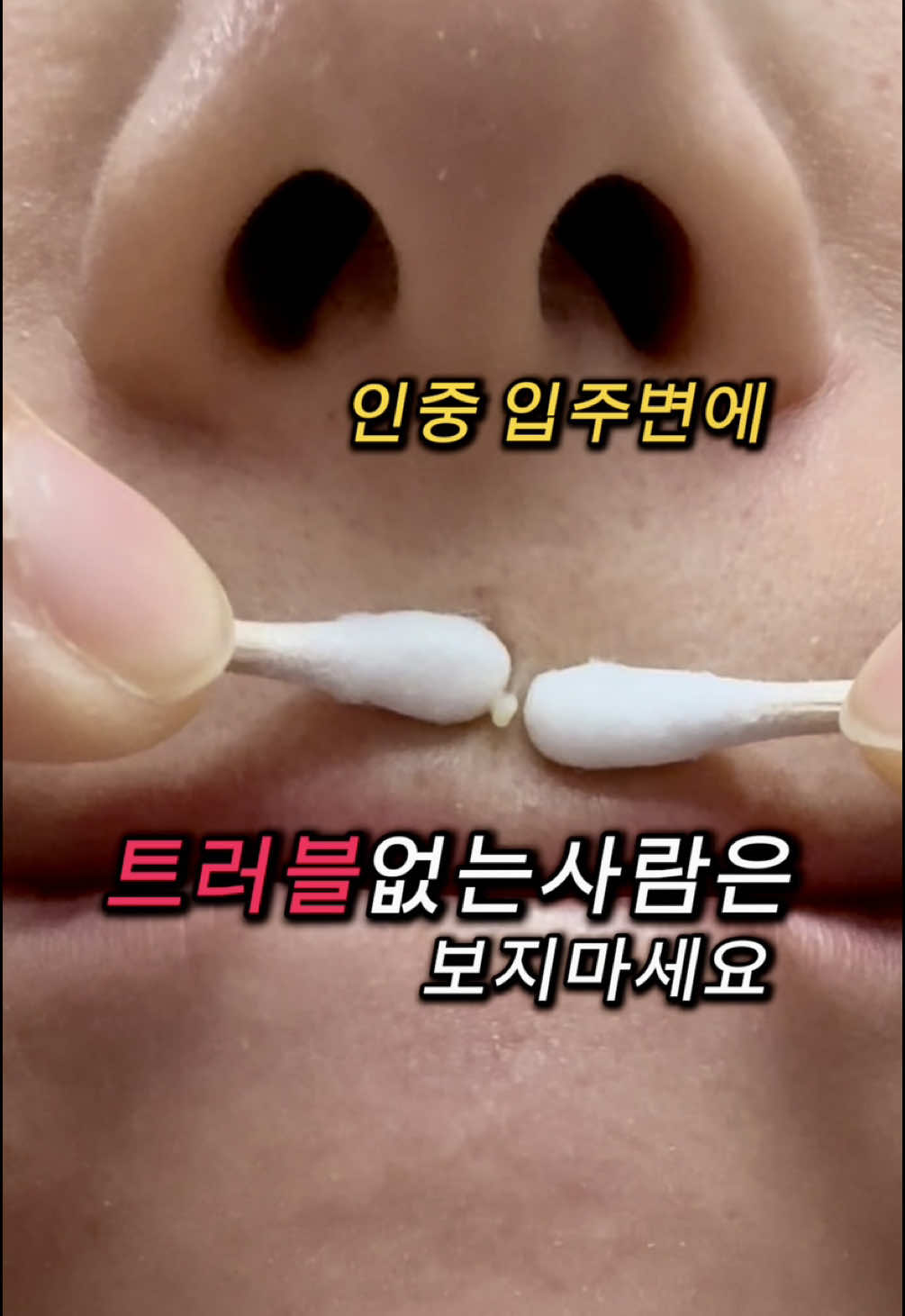 피부전문가의 집에서 하는 트러블 응급관리 꿀팁✨ 트러블 짜고 여드름 패치  붙이시나요? 오히려 염증 악화  색소침착 위험이 있을 수 있어요 여드름균은 산소를 싫어하는 혐기성균 패치로 피부를 밀폐하면 균이 더 활발해지고 회복이 느려질 수 있습니다 ✔ Step 1. 멸균 니들로 트러블 살짝 오픈 ✔ Step 2. 면봉으로 가볍게 압출 ✔ Step 3. 바르는 재생패치로 진정 + 재생 + 흉터 예방 ✨피부샵 안 가고도 가능한 전문가 루틴 ✅피부보호막흉터예방 다이메티콘 ✅색소침착방지 글루타치온 ✅재생 탄력에 토코페롤  성분가득한 바르는 이 겔패치 온 가족 사용가능한 피부응급겔 바르는 패치정보가 궁금하시면  📌댓글에 “패치겔”남겨주세요 패치겔정보와 14000원 할인 링크 보내드릴께요🚀 #트러블관리 #흉터예방 #색소침착예방#여드름흉터 #압출후관리 #픽시카