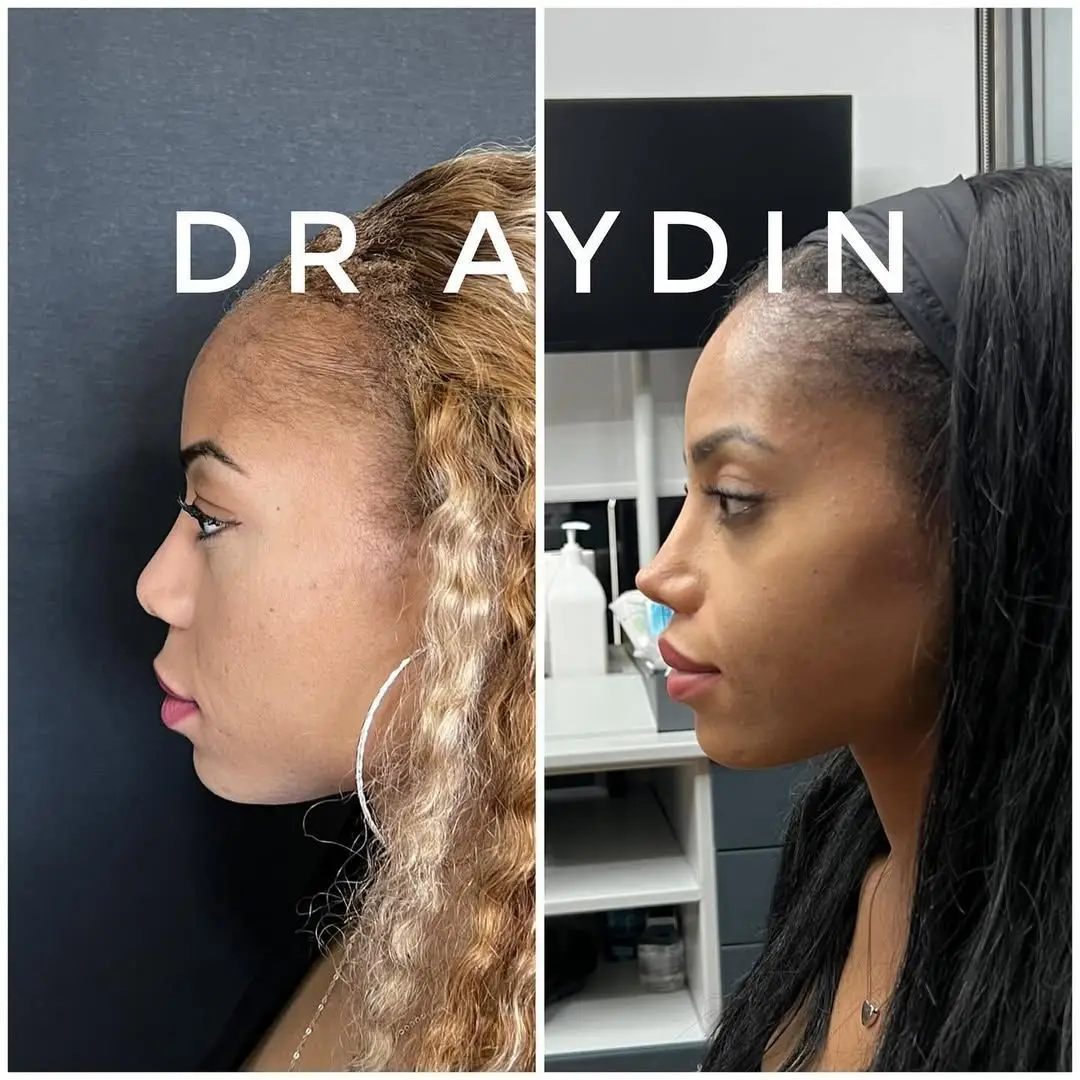 Complicated Revision Ethnic Rhinoplasty Result About 2 years ago, we performed revision rhinoplasty surgery on our patient with rib graft and composite ear graft. Then we performed touch up surgery on our patient’s nostrils. Now it is a more aesthetic and functional nose. #rhinoplastyturkey #rhinoplastyistanbul #rhinoplastie #rhinoplastybeforeandafter #rhinoplastyexpert #ethnicrhino #ethnicrhinoplastyinistanbul 