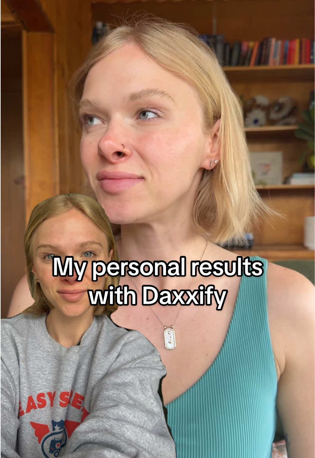 The eyebrow lift with Daxxify is INSANE!!  I’m so obsessed & I’m so excited to be in this industry! 💉💕✨ #softnursing #dermatologynurse #nursesoftiktok #daxxify #botox #cosmeticnurse #nurseinjector 