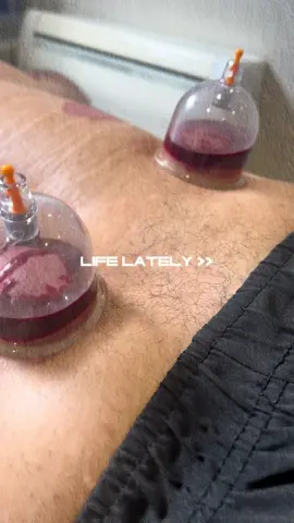 How has your life been lately? Mine consists or cupping, healing, and more cupping 😀 #hijama #cupping #hertscupping #cuppingtherapy #hijamatherapy #naturaltherapy #bodydetox #stressreliever 