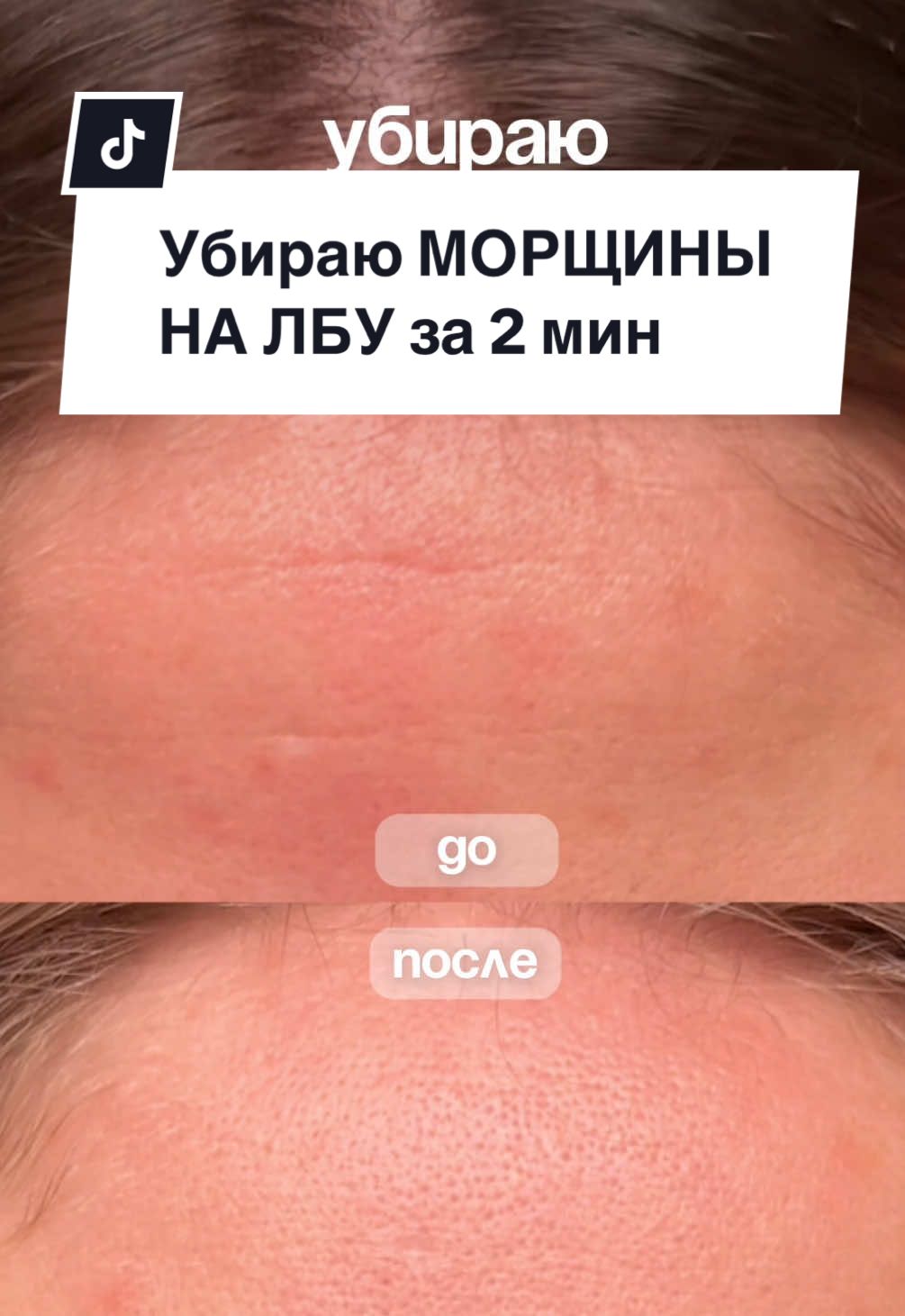 Показываю на себе 🔥 В след раз на маме попробую 🙃 Арт. сыворотки 142054897 РП | #морщиныубираем #морщины #ретинол #морщиныналбу  @glossystay 