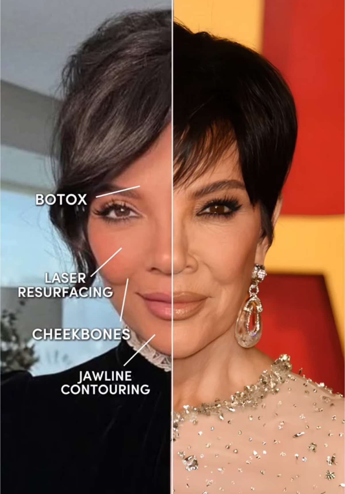 Kris Jenner didn’t just age ✨ she upgraded! 👑 Looking flawless at 69 and reminding us that the secret isn’t magic… it’s maintenance. 📍Book your FREE consultation at Danik! 🩵 #krisjenner #botox #facelift #necklift #filler #medpsa #medspalife #skincaremiami #LaserTreatment #AestheticExperts #beauty #GlowUp #SkinCareRoutine #miami #explore #fyp  #aestheticnurse #reel #funny #Love #fypシ #fillers #esthetics #trending #SkinGoals