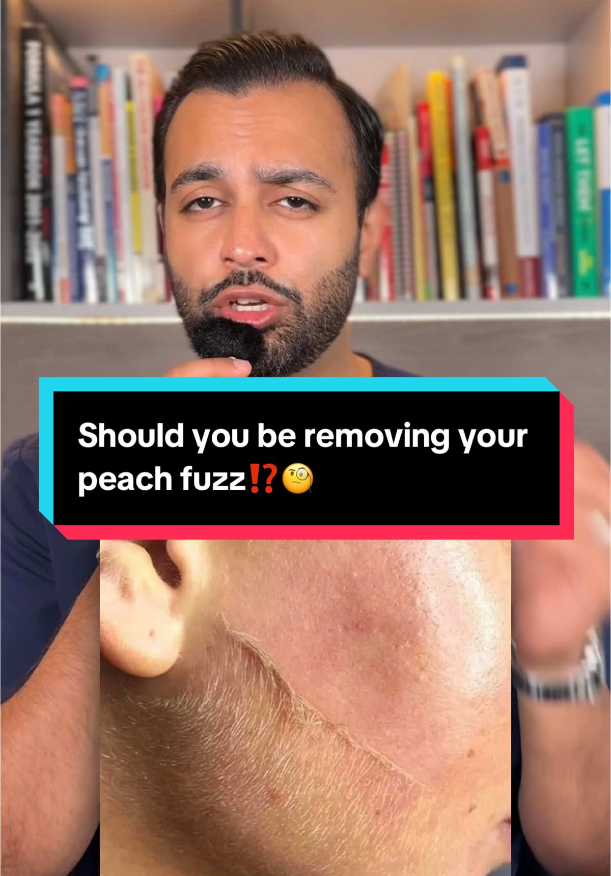 Should you get be removing your peach fuzz? Here’s what I tell my patients as a skin doctor. #PeachFuzzFacts #SkinDoctorTalks #ShavingYourFace #DermaplaningMyths #FacialHairRemoval #SkinTipsFromADoctor #PeachFuzzExplained #SkincareAdvice #DoctorApprovedBeauty #RealSkinTalk 