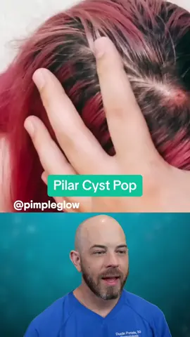 ❌ Never pop a cyst with bare hands, seriously! (Credit:  @pimpleglow on TikTok) #cyst #satisfying 