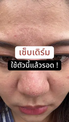 ใช้ต่อเนื่องมา 2 ปีแล้ว ผิวหน้าดีขึ้นมากๆ 🫶🏻😍  #resiskin #เซ็บเดิร์ม  #ผิวหน้า #ผิวแพ้ง่าย  #สกินแคร์ #skincare  #รีวิวของดีบอกต่อ #รีวิวเอง 
