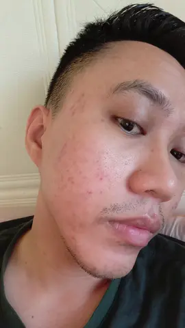 trifill after day 2 #scar #scartreatment #bopeng #trifillpro 