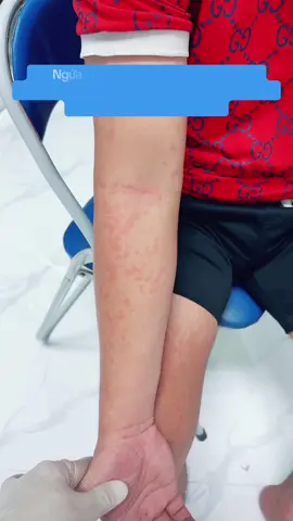 Bệnh nhân nhiễm giun đũa chó Toxocara canis #đào thải ký sinh trùng
