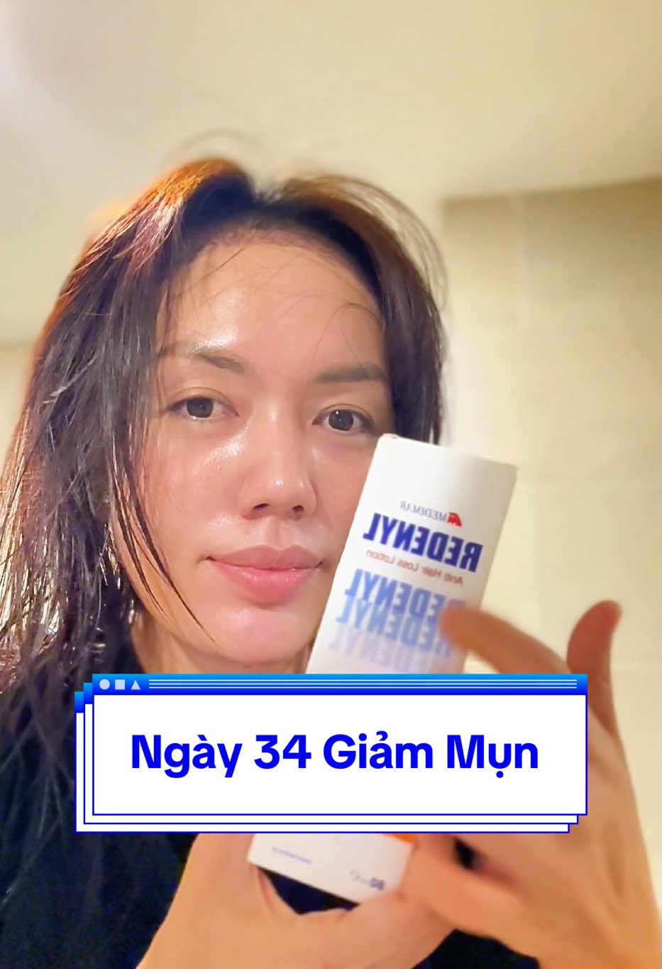 Ngày 34 sau cấy tóc – tóc con đang nhú, da đầu đã ổn! Mụn viêm cũng được “dọn dẹp” gọn gàng luôn 💪✨ #reviewcaytoc #caytoctuthan #hànhtrinhthaydoibanthan #CấyTóc #cấytócreview 