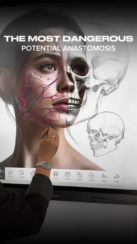 The Most Important Anastomoses to Know in Aesthetics 💉🧠 Some vascular connections carry more risk than others—and knowing where they are is critical for safe injecting. ✔️ High-Risk Zones – Multiple arteries link deep and superficial planes ✔️ Depth & Angle – The way you enter the tissue can change everything ✔️ Anatomy First – Always map danger zones before you inject Mastering these pathways isn’t optional—it’s essential. Join my subscription for full anatomical breakdowns and injection safety tips. #aesthetictraining #injectorsafety #vascularanatomy #fillercomplications #medicalaesthetics #anatomymatters #safeinjecting 