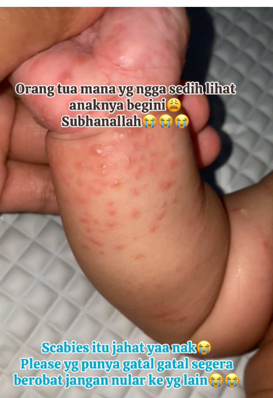Wajib berobatt! Jauhi anak kecil! #fyp #scabies #gatalgatal 