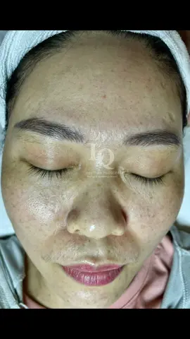 Da sạm nám#lấynhanmunbangtay#chamsocdamun#chamsocdaseo#chamsocdanam#tanbinh#govap #Lequynh#Lqspa#hocnghespa  #chamsocda #lequynhspa #lequynhspahcm#vienthammylqspa#lqspabeautyacdemy#LQSPABeaty&Acedemy  #laymunbangtămbông 