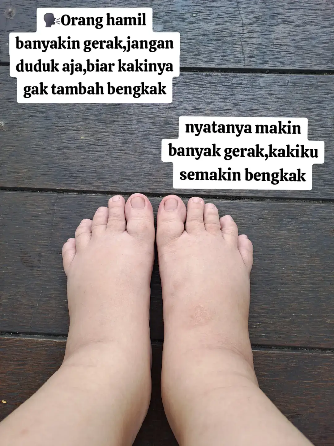 Oh iya kaki bengkak ku ini normal yah,karena tidak disertai tekanan darah tinggi dan aku sudah cek protein urin,hasilnya negatif #bumil #fypシ゚ #kakibengkakibuhamil #kakibengkaknormal #kakibengkaksaathamil 