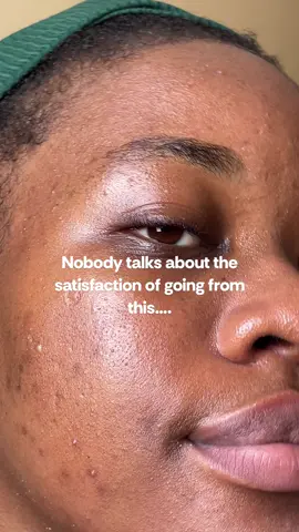 Same lighting, same spot, same girl, same face but coupled with consistency, patience and a lot of trial and error!! But being consistent and loving my skin through it all!! It’s not where I want but it’s perfect!! #skincaretransformation #beforeandafter #skincareroutineforacne #acneproneskin #darkspottreatment #hyperpigmentation #clearskintips #healthyskin #skintransformation 