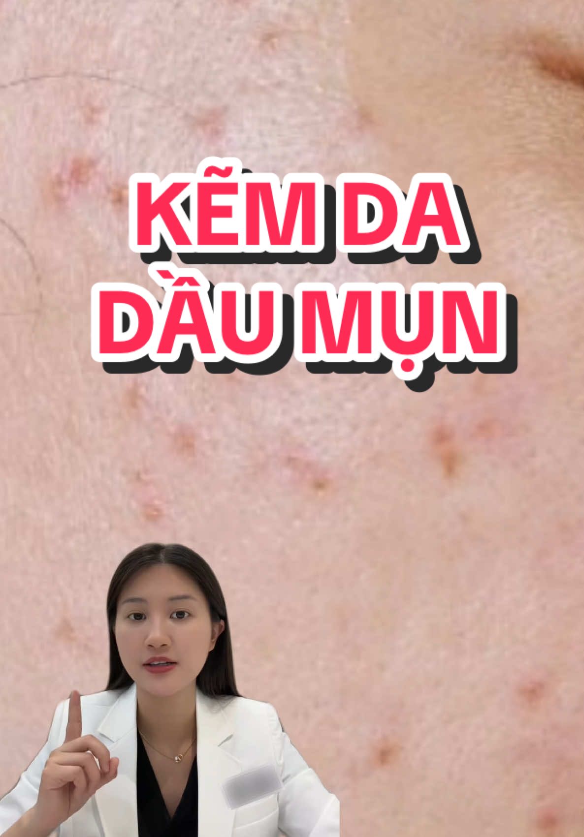 Da dầu mụn có nên dùng kẽm #bskhonghanhnguyen #BeautyTok #skincare #ekseption #kẽễmkseption 