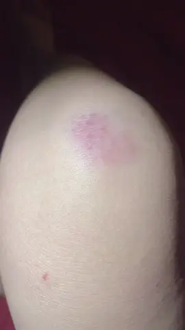 Người ta đi xe còn không ngã mình đi bộ mà ngã xước hết cả chân như này thì làm được cái gì nữa🤨🤨🤨