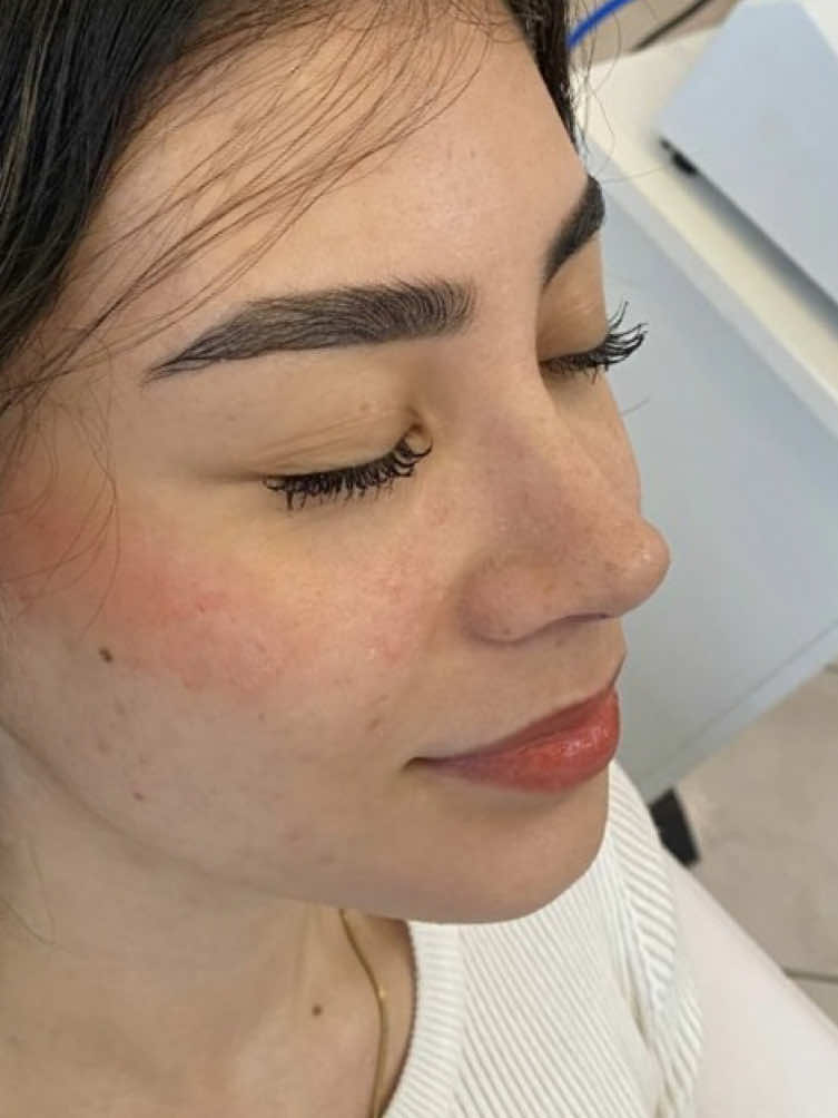 Detalle, arte y pasión por lo que hacemos, es lo necesario para resaltar tu mejor versión ✨👌 ¿Deseas realizarte una Rinoplastia o conocer más al respecto? Envíame un Mensaje Directo con la palabra ”Rino”  . . . #drjoseluisbetancourt #cirujanoplástico #santodomingo #ecuador🇪🇨 #rinoplastia #rhynoplastic #nariz #mujer #cirugíaplástica 