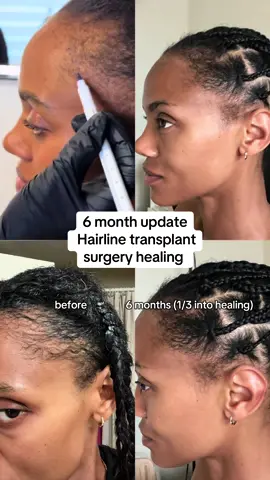 Replying to @Brown Mama Watch the playlist so you can see the journey and @Doctours is the best place to find your surgeon! Link in bio for more info on how to start the journey  #hairline #hairlinetransplant #surgery #surgerytiktok #plasticsurgery #BlackTikTok #blackwomen #alopecia #tractionalopecia #hairtransplantturkey #femalehairtransplant #womenhairtransplant #doctours #doctours7046 #fyp #viral #hairtransplant #tijuana #mexico 