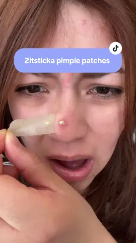 Come with me to get rid of this 2 headed MONSTER 😭😭😭😭 #pimplepatches #zitsticka  #pimplepopper #pimple #skincare 