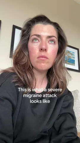 It’s not a headache  #migraine #InvisibleIllness 