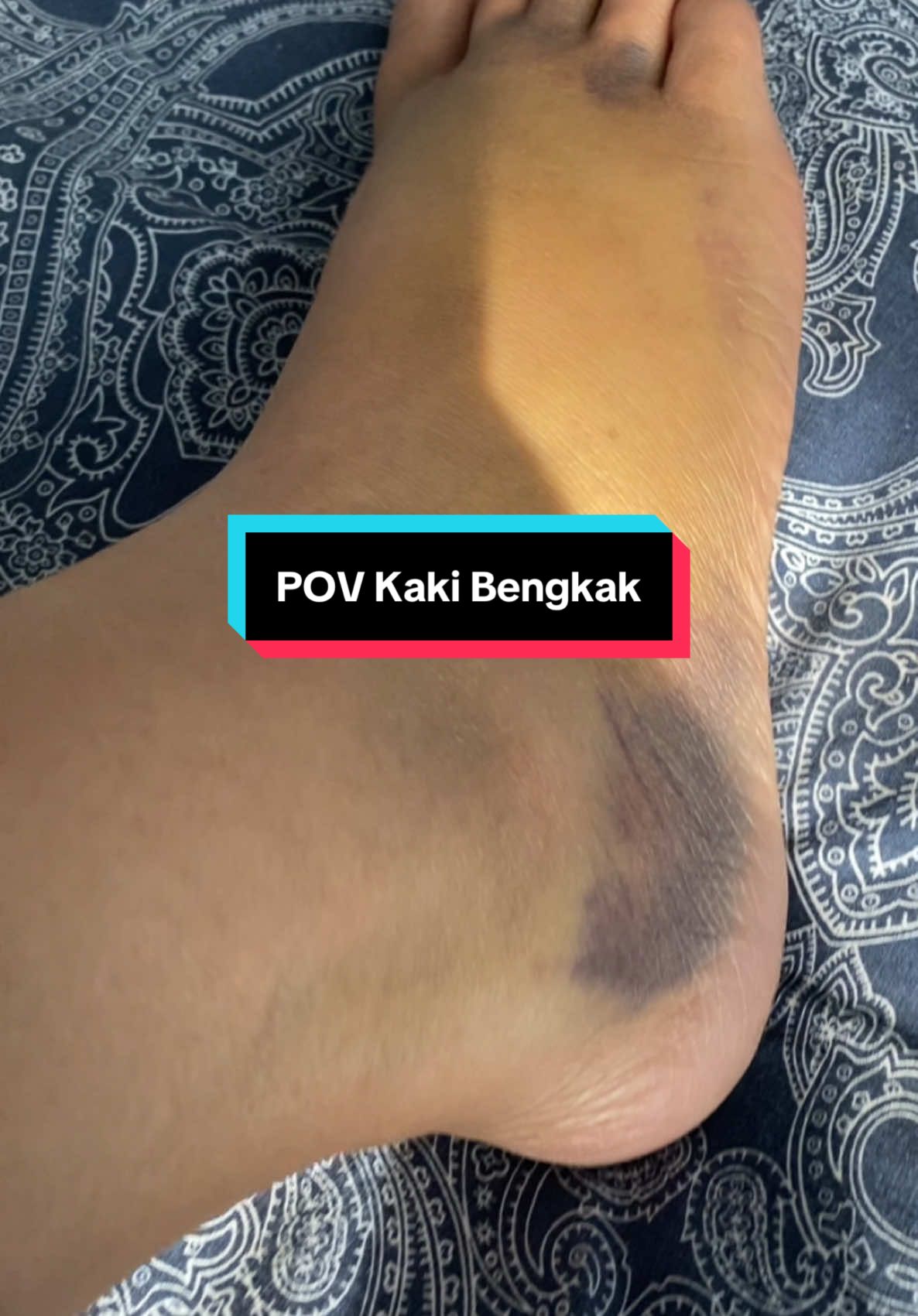 Day 13 jatuh katil, masih bengkak, lebam dan hitam …. Sy serik … #jatuhkatil #fyppppppppppppppppppppppp #foryoupage #leginjury #leginjuryrecovery 