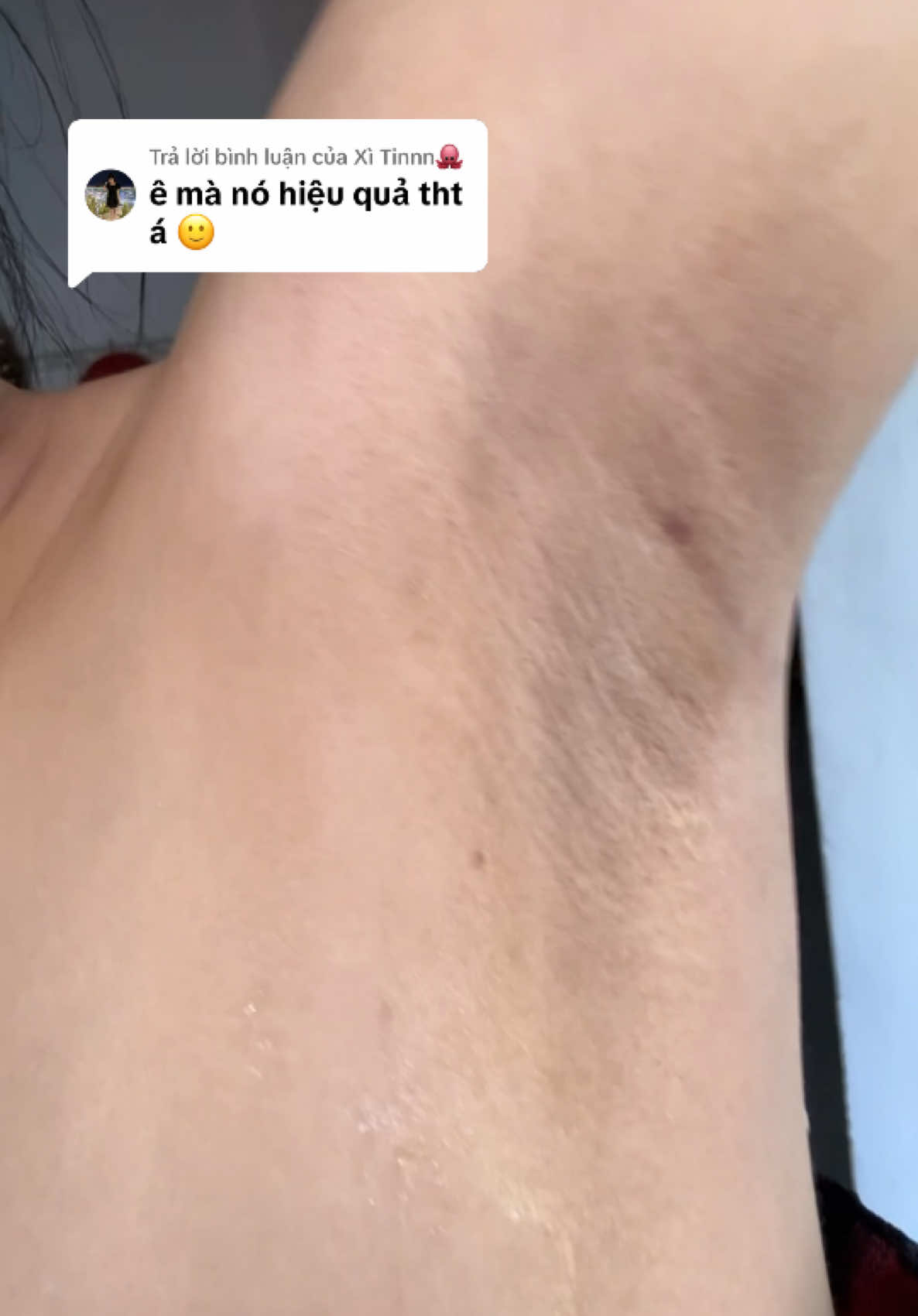 Trả lời @Xì Tinnn🐙 nên dùng từ 2 hủ là cái nách nó trắng bóc luôn á nha  #tritham 