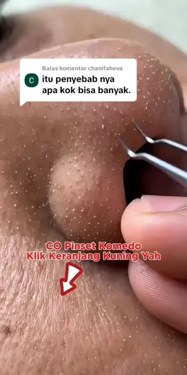 Membalas @chanifaheva pinset pencabut komedo hidung #pinsetkomedo #alatpencabutkomedo #komedohilang #komedohidung #komedo 
