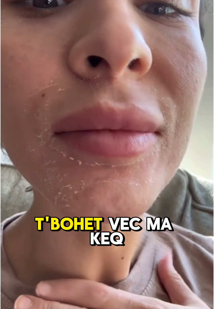 A po e ndjen lëkurën si me u shtrëngu, si me t’u ça? Kjo s’është veç tharje – është alarmin që lëkura ka etje. Shea butter t’a zbut, t’a ushqen, edhe t’a kthen butësinë që ka humb.  #sheabutterhandcream #sheabutterproducts #sheabutterbenefits #lekureeThate #sheabutter #skincareShqip #dehidrim #kujdesiperfytyren #naturalcare#LusciousBalm #KujdesiLekures #LëkurëEShëndetshme #ParaDhePas #SkinCareAlbania #LekureNatyrale #eczema #dermatitis #tharjelekure #glonamskincare #lusciousbodybalm #lekura #ekzema #psoriaza #irrituar #kujdesi #shendeti #eczema #ekzema #psoriasis #psoriasisawareness #eczemaflareup #skincare #glonam #glonamskin #lekura #kujdesi #kujdesiperlekuren #itchy #prishtina #kosova #maqedonia #shqiperia #prishtinacity #blej #blejonline #blejonlinekosove #fyp #foryoupage #viral_video #videoviral #truestory #albania #shqiperia #maqedonia #kosovo #kosovatiktok 