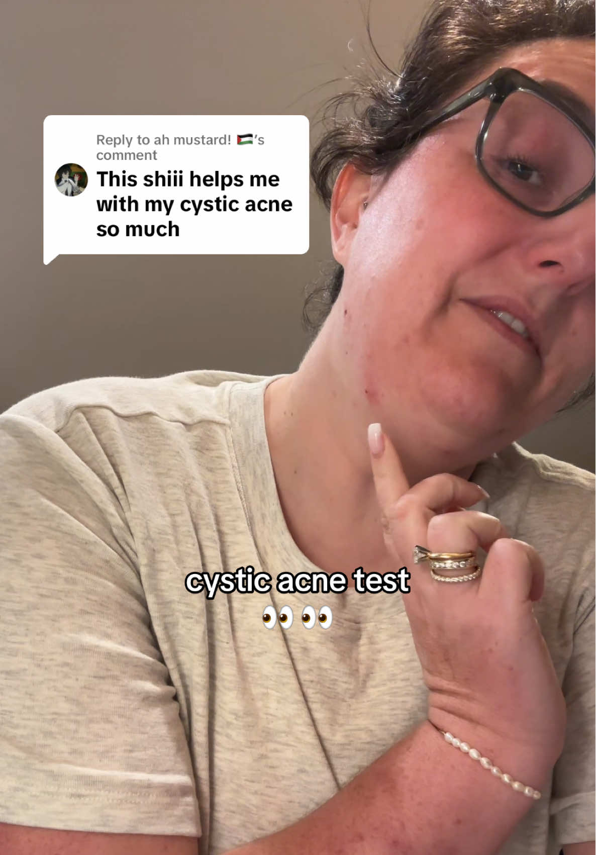 Replying to @ah mustard! 🇵🇸 perfect timing.. I’ve been messing with this all day 🫩🥲 #cysticacne #tiktokshopcreatorpicks #tiktokshoprestock #tiktokshopsummersale #pimplepopping #pimplepopper not medical advice.