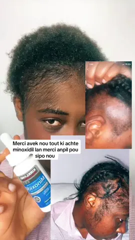 ##minoxidil #minoxidilresult #minoxidilfoam #minoxidilbeard #minoxidilkirkland #minoxidilkirkland #minoxidilresults #minoxidilhairgrowth #minoxidilhairgrowth #bestone #bestreview #honesty #viral? #fyppppppppppppppppppppppp #fypシ #yp #viralvideo #viral 