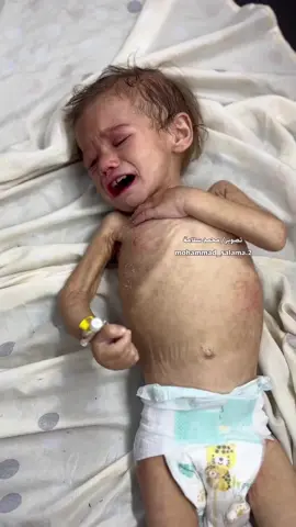 *⚠️ Urgent Appeal To Save Maryam!* Three-year-old Palestinian child, Maryam Abu Daqaa, is suffering from severe malnutrition and dehydration as a result of the brutal Israel siege on the Gaza Strip.  Maryam used to weigh 10 kilograms — today, she weighs only 4. Her condition is critical and she urgently needs medical treatment outside the Gaza Strip. Maryam's father holds official medical reports and approval from the World Health Organisation.  *All he asks is for your help to get her out of Gaza so she can receive life-saving treatment abroad.* Please share and forward! #fyp #viral_video #humanity #fypシ #Foryou 