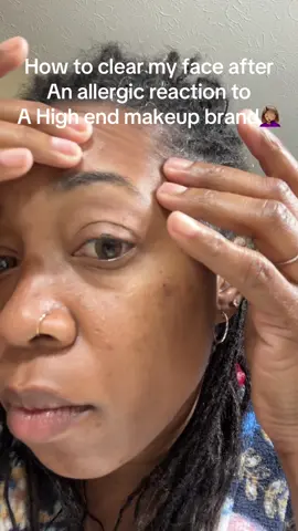 Jiyu has made the recovery from an allergic reaction so much quicker. I figured if it can clear acne, smooth skin, and improve discoloration, it could easily soothe these hives! #jiyu #allergicreaction #sensitiveskin #skincare #koreanskincare 