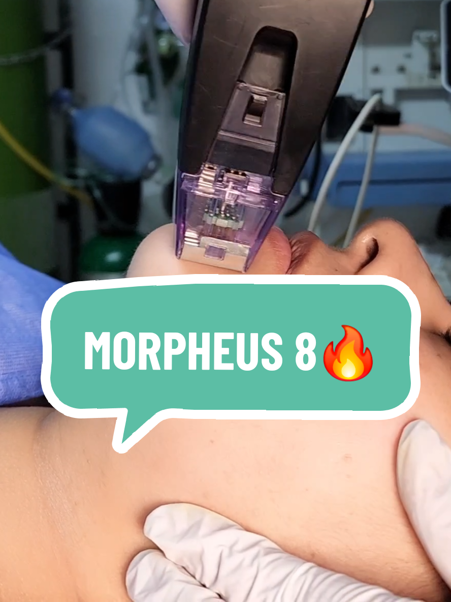 MORPHEUS 8, el favorito de nuestros pacientes✨️agenda tu cita o visítanos en San Borja sur 416📍 #morpheus #morpheus8 #tratamiento #belleza #facialtreatment #morpheus8treatment #rejuvenecimientofacial #rejuvenescimento #tensadofacial #antiedad #flacidezfacial #flacidez #lipofacial #dradianaespinal #lima #perú #fyp #fypシ゚ 